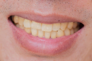 Close-up of smile with yellow teeth