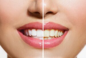 Comparison between yellow and white teeth.
